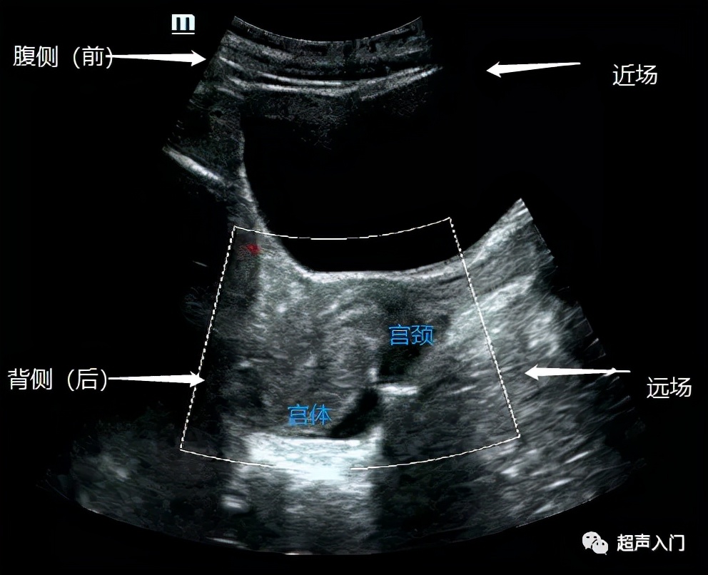 超声如何判断子宫位置,超声上怎么判断子宫后位