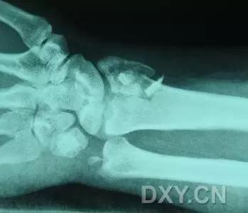 特殊骨折类型,特殊骨折体征