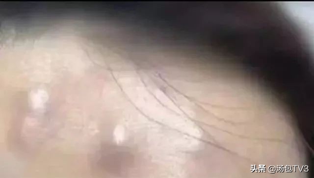 女子打瘦脸针,女子打瘦脸针导致皮肤溃烂