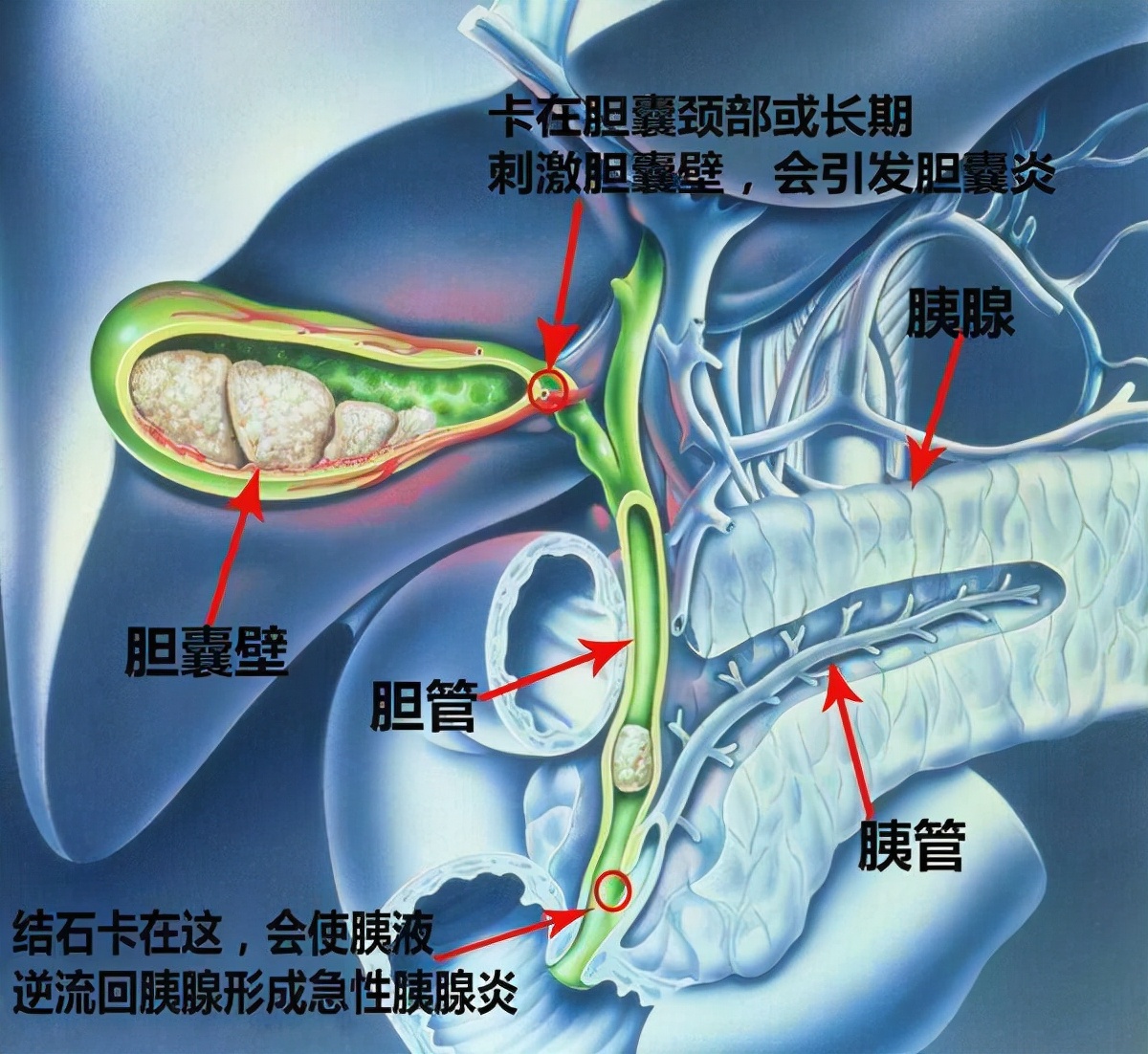 一直在犹豫胆结石需不需做手术,6厘米胆结石治疗最佳方案