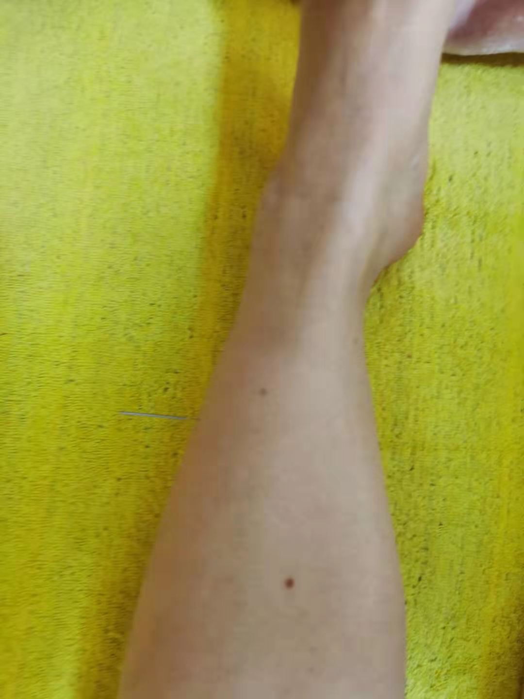 倪海厦失眠针灸案例,针灸治失眠的视频