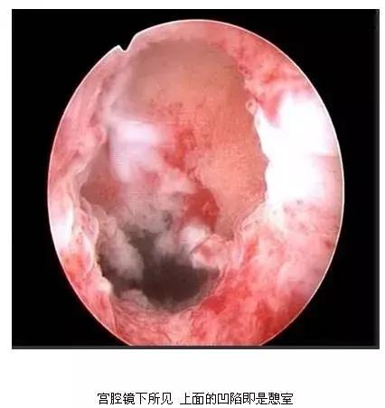 子宫憩室手术后怎么调理身体,子宫憩室手术后还会有憩室吗