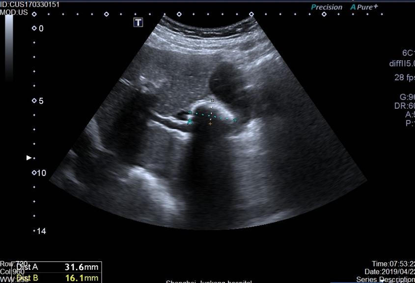 胆结石怎样才能把石头排出来,胆结石怎么消除