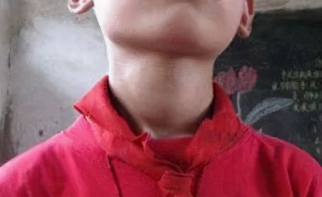 全国甲状腺知识宣传周,国际甲状腺知识宣传周央视