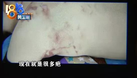 拔火罐酒精在背上烧着了咋办,女子拔火罐后背烧伤