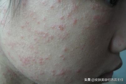 痘痘反反复复，脸上坑坑洼洼，到底是什么原因？