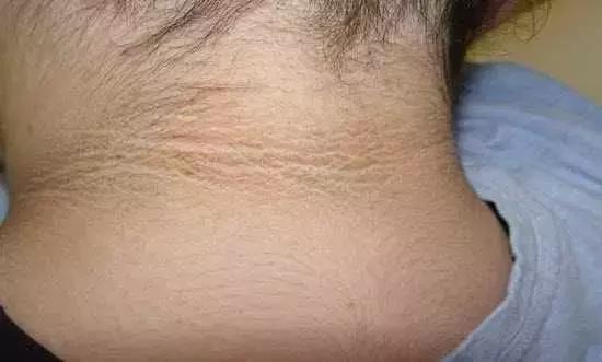 糖友易出现又纠结的8种皮肤病变，医生来支招