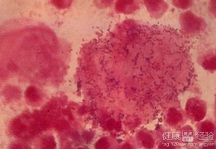 妇产科医生教你：从*裤内**看自己是否有妇科病