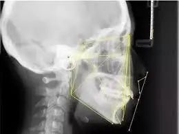 超便宜隐适美,网上买隐适美靠谱吗