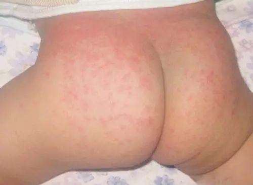 宝宝红屁股了该怎么护理好,宝宝红屁股怎么护理好得快