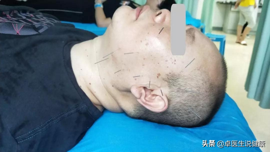 中医颊针案例分享:颈部包块20年,通过中医颊针疗法解决问题