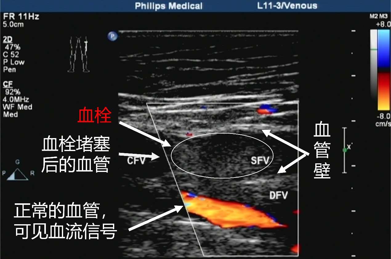 深静脉血栓会是癌症引起的吗,为什么癌症的人容易肺感染