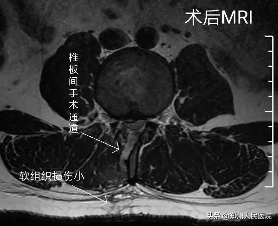 对骨科微创技术的认识,骨科手术与保守治疗对比