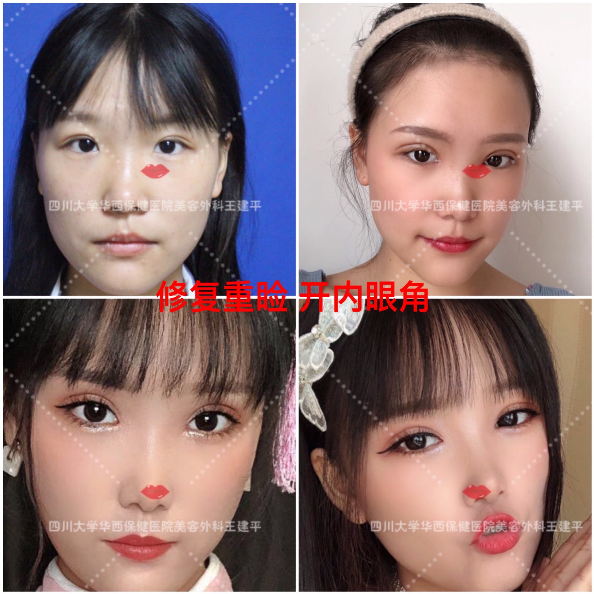 怎么知道自己最适合哪种双眼皮,双眼皮有哪几种类型图片