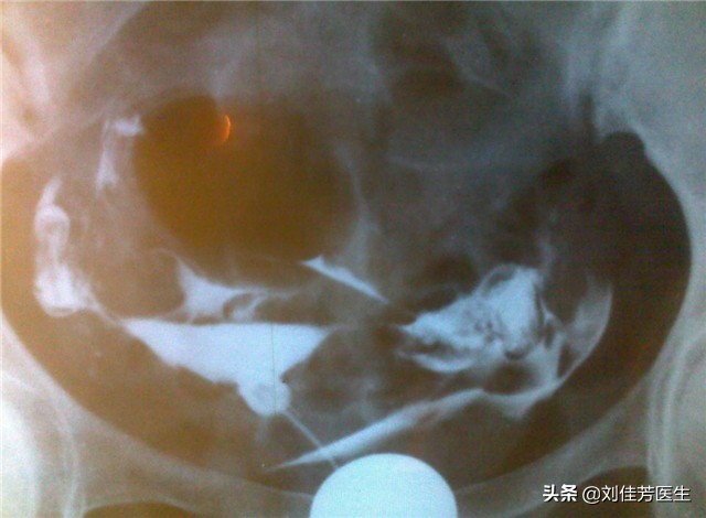 输卵管堵塞最有效的疏通方法,输卵管堵塞疏通妙招