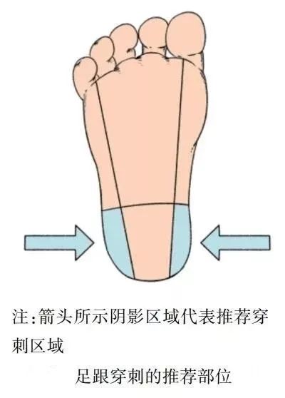末梢采血如何出更多血,中国末梢采血操作共识解读