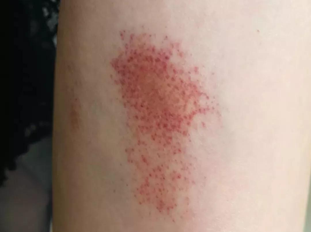 色素性紫癜性皮肤病是啥,色素性紫癜性皮肤病是什么