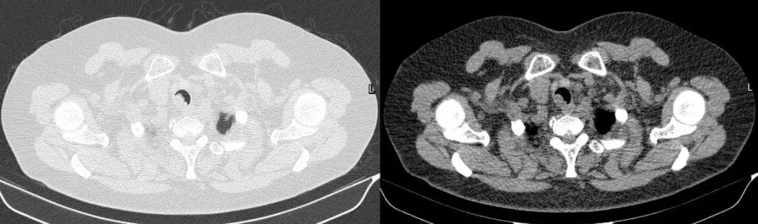 儿童90%为良性,成人却不到10%?患者气短3年,胸部CT提示的气管肿物意味着什么?气管镜有何发现?