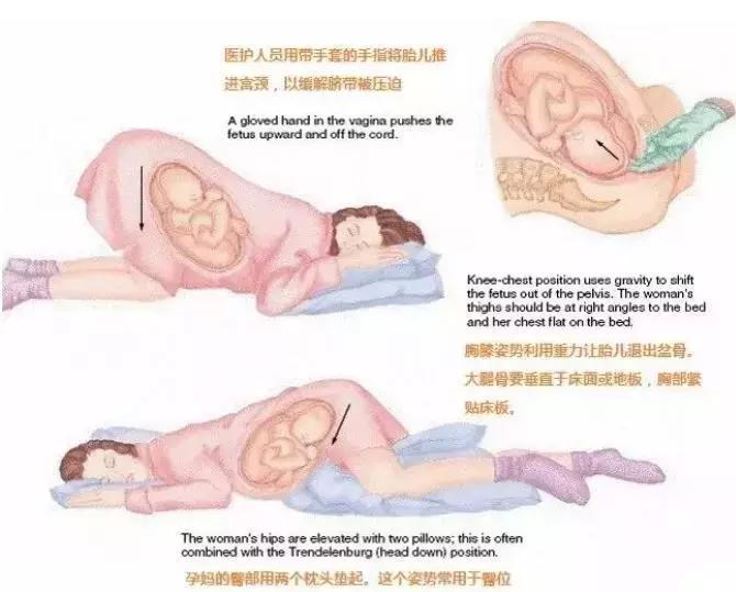 她破水后差点失去了宝宝,幸好没耽误1分钟!