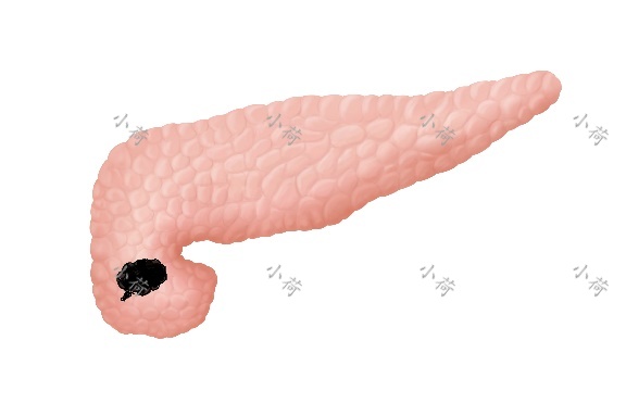 胰腺癌活到123岁,晚期胰腺癌居然活了二十年