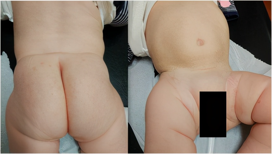 尿布疹会引起哪些症状呢,顽固性尿布疹能引起银屑病吗