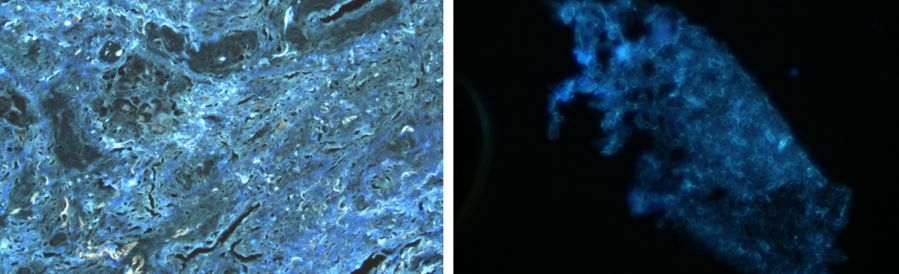 慢阻肺患者合并真菌感染,慢阻肺和真菌定植有关系吗