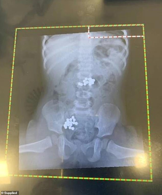 澳洲母亲一会功夫没管女儿出意外：一岁女儿竟吞下32个磁铁球