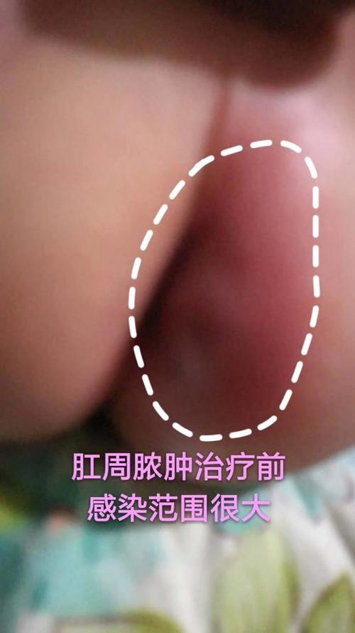 儿童预防细菌感染疫苗,婴儿肛周脓肿接种禁忌