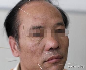 得了面瘫该怎么治疗,外国人面瘫怎么治