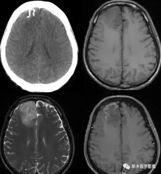 颅内有钙化怎么治疗,34岁脑部有钙化正常吗