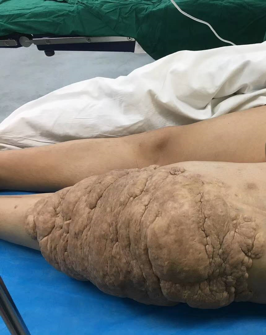 500斤男子减肥手术除赘皮,男子全身长脂肪瘤怎么办