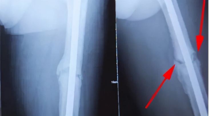 骨折术后为什么总是不舒服,骨折术后为什么有的人不愈合