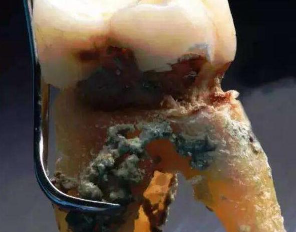 牙缝里面的东西臭臭的怎么解决,牙缝中黄色的污垢臭臭的