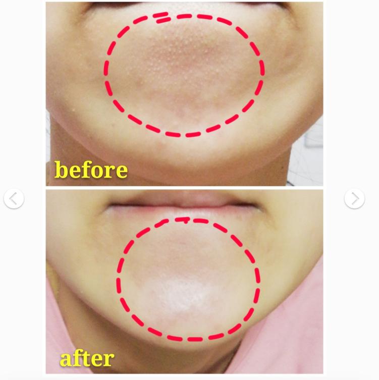 消灭闭口粉刺正确护肤方法,闭口性粉刺可以补水护肤吗