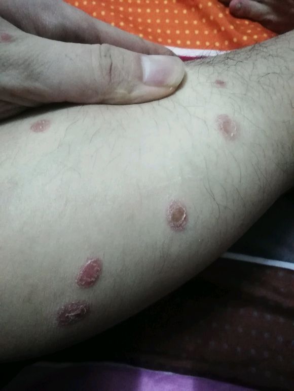 猫咪得了猫癣比较严重怎么办,猫咪得了猫癣能彻底治愈吗