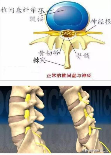 腰椎间盘突出最好的影像诊断方法,腰椎间盘突出的影像学检查