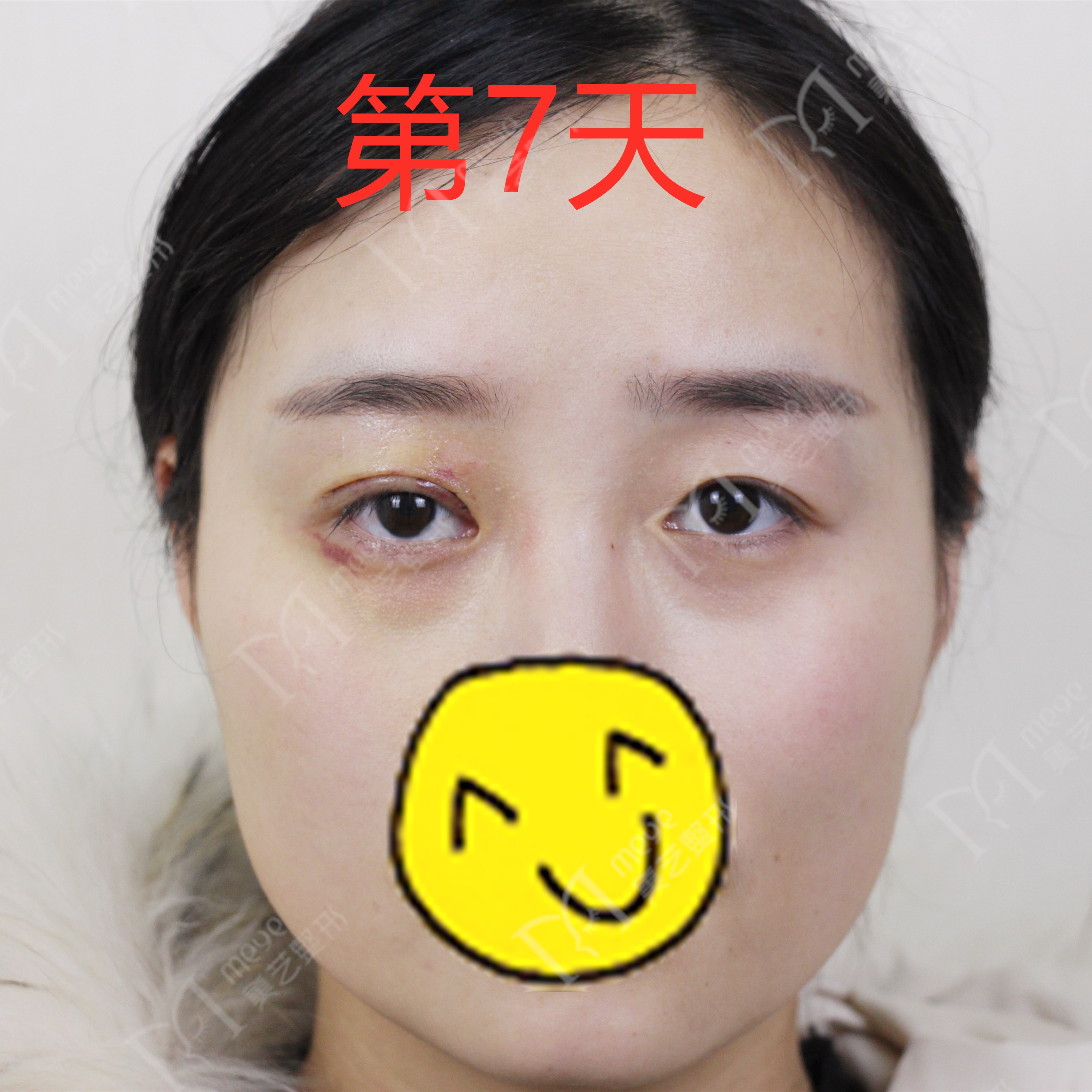 女子双眼皮术后大小眼,大小眼做了双眼皮感觉眼角不对称