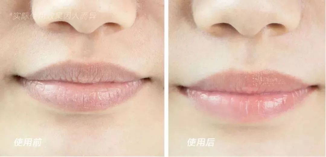 在线等，接吻时咬下女友的死皮，怎么办？