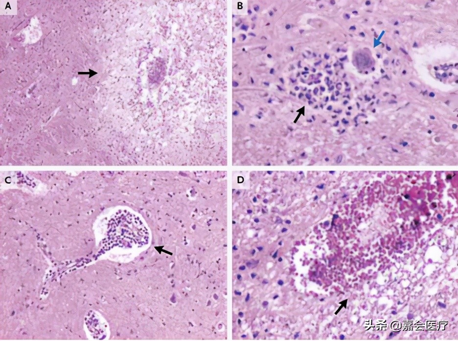 手足口病你必须知道,手足口病最新版知识解读