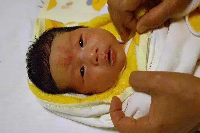 怀孕湿疹反反复复如何彻底根除,孕妇湿疹怎么治好得快