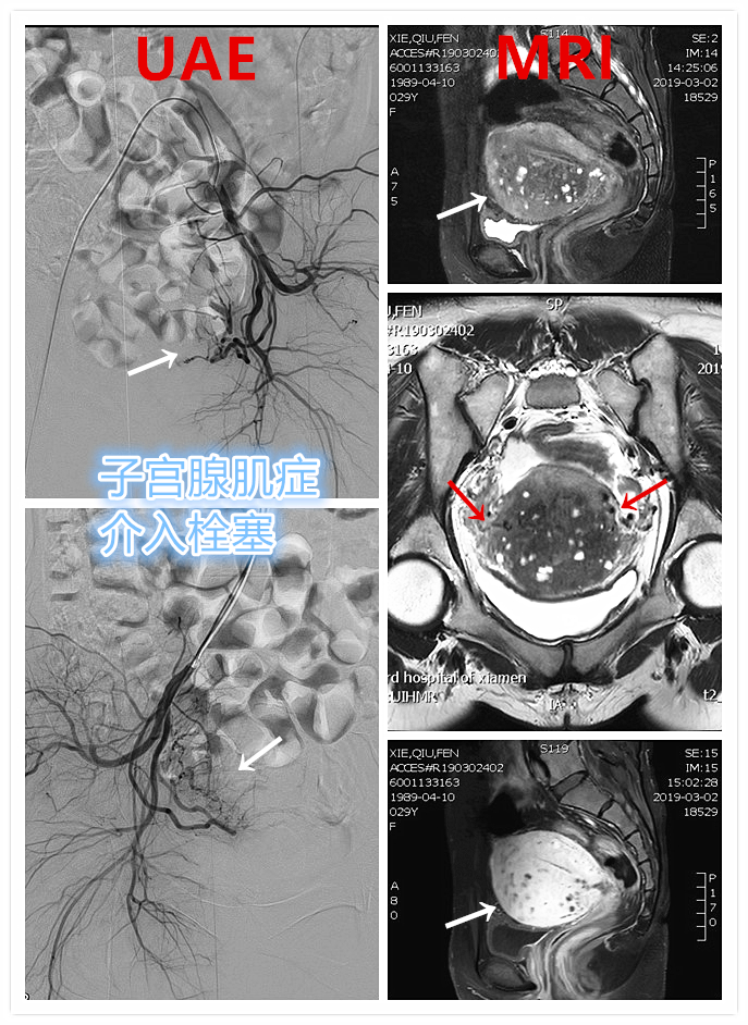 「不死的癌症」之克星——子宫腺肌症介入栓塞治疗