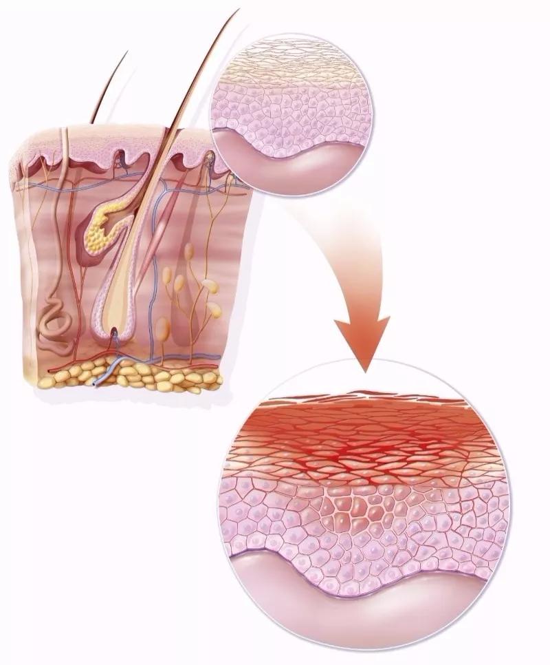 怎么区分激素脸和过敏脸,过敏脸与激素脸的区别