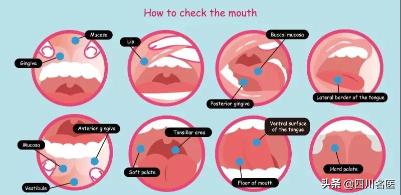 口腔溃疡超过2个月就是口腔癌,口腔溃疡变成唇炎