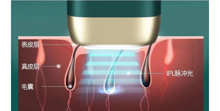 j-style脱毛仪,j-style脱毛仪怎么样