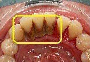 洗牙多长时间洗一回,洗牙多长时间洗一次牙垢