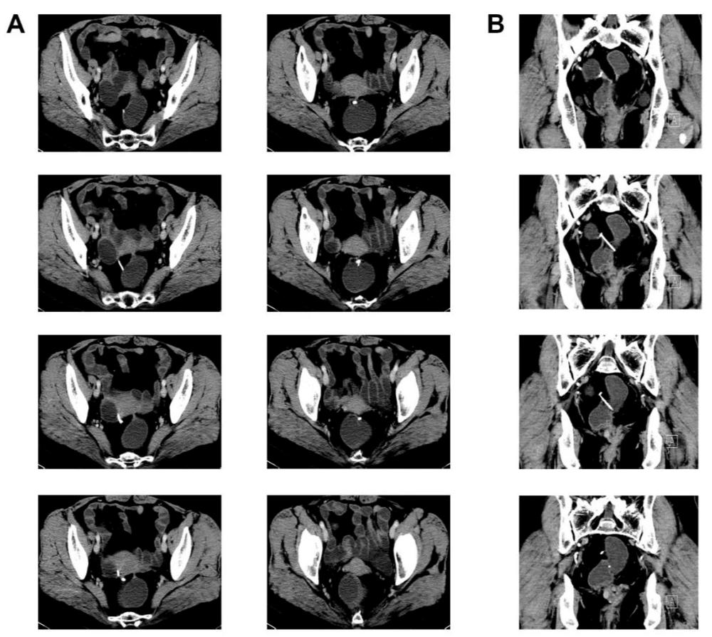 放了节育环三十年了现在取行吗,放了30多年的节育环还能怀孕吗