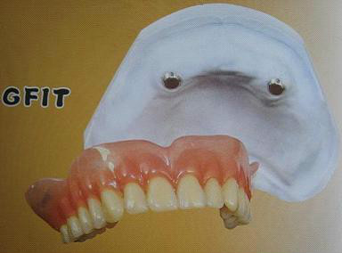 假牙价格一览表图片,假牙种类及价格表图片