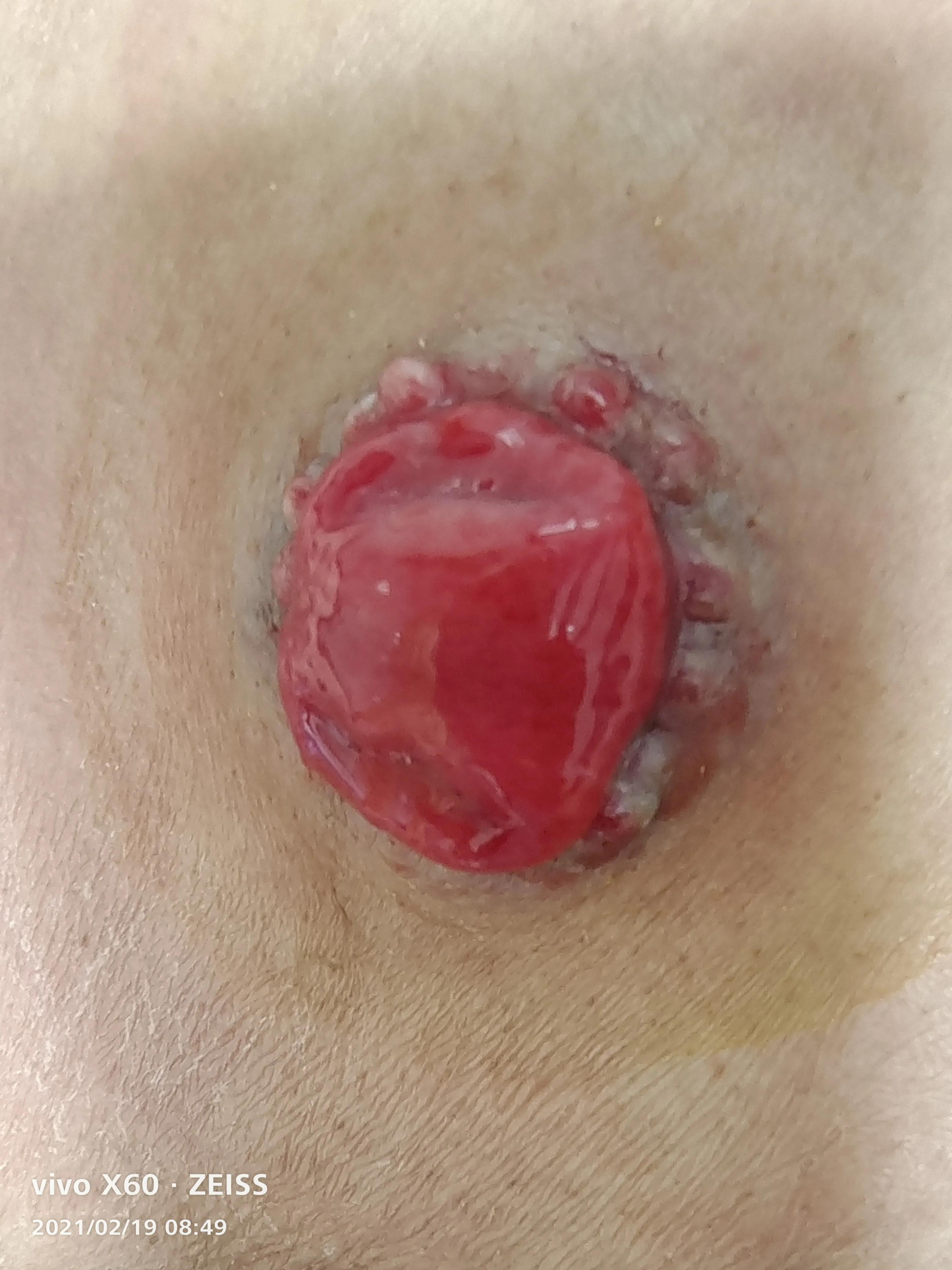 造口周围出现肉疙瘩,造口旁边长了个小肉疙瘩