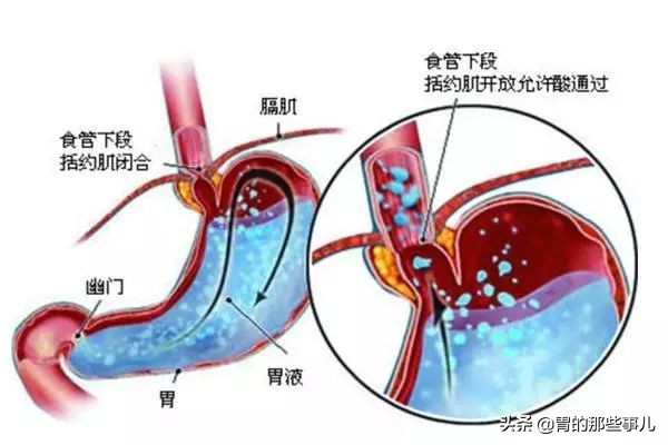 我肠胃炎犯了怎么办,肠胃炎反复发作会致癌
