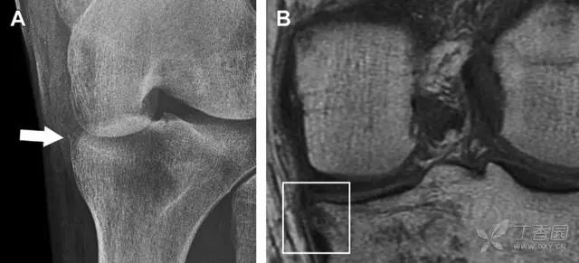 几种严重骨折医学名称,常见的骨折有哪些名称